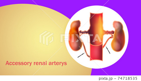 Accessory renal arteries Accessory renal arteries 74718535