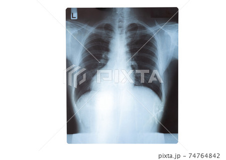A chest x-ray film of a patient. Medical Education. Abnormal xray in lung infections. Covid 19 pneumonia. A chest x-ray film of a patient. Medical Education. Abnormal xray in lung infections. Covid 19 pneumonia. 74764842