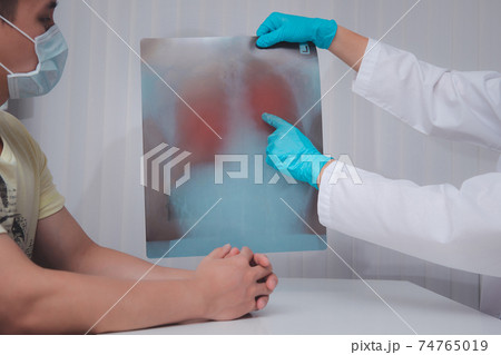 Doctor explain Coronavirus Disease 2019 or Covid-19 displayed on x-ray film to patiant. The film shows symptom of corona virus infect patient lung and respiratory organ. Doctor explain Coronavirus Disease 2019 or Covid-19 displayed on x-ray film to patiant. The film shows symptom of corona virus infect patient lung and respiratory organ. 74765019