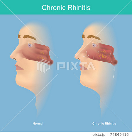 Chronic Rhinitis. This illustration medical use for explain comparison chronic rhinitis symptoms have mucus in the nose and throat. . 74849416