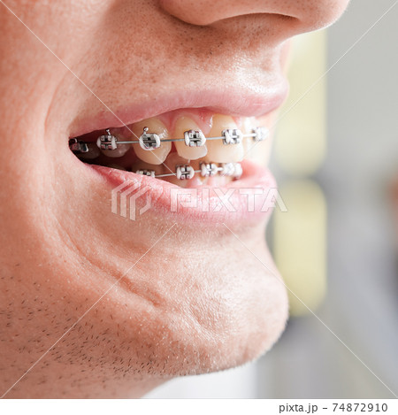 Macro photography of human's mouth with metal braces on teeth 74872910