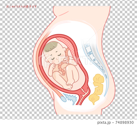 逆子の赤ちゃんのイラスト(テキスト付き) 逆子の赤ちゃんのイラスト(テキスト付き) 74898930