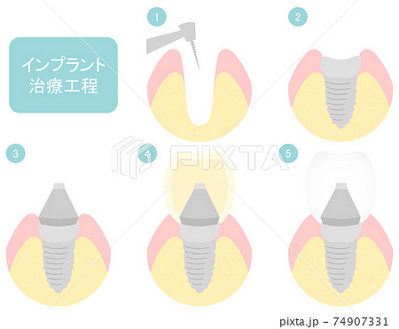 歯のインプラントの治療工程イラストのイラスト素材