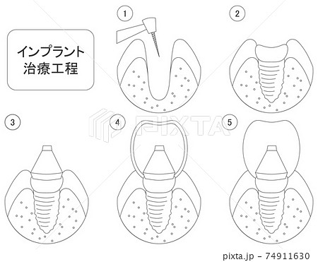 歯のインプラントの治療工程イラスト線画 74911630