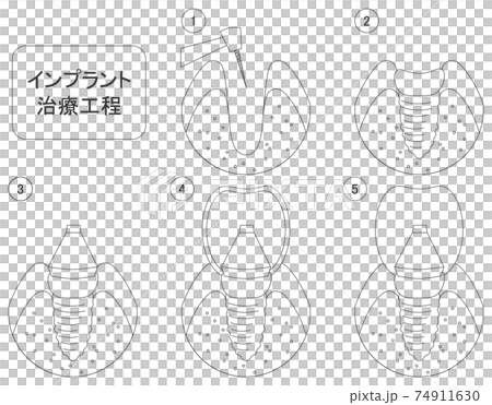 歯のインプラントの治療工程イラスト線画 74911630