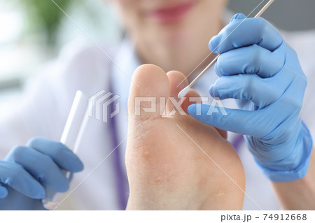 Doctor treating patients toes in clinic closeup 74912668