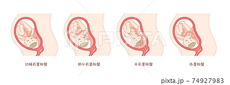 前置胎盤の赤ちゃんと子宮 前置胎盤の赤ちゃんと子宮 74927983