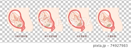 前置胎盤の赤ちゃんと子宮 前置胎盤の赤ちゃんと子宮 74927983