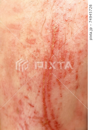 Bloody scrapes on the skin Bloody scrapes on the skin 74945726