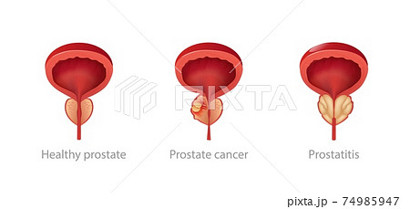 Stages growth prostatitis and tumors. Pathological disruption of male gland with enlarged into malignant genital impaired reproductive function. 74985947