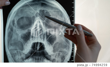 X-ray of the human head. The doctor points out the signs of sinusitis 74994259