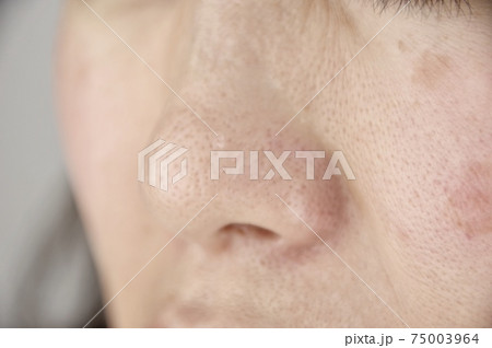 女性の肌トラブル アップ 女性の肌トラブル アップ 75003964