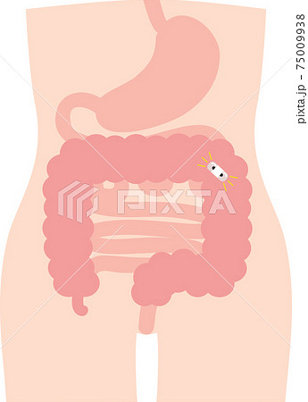 カプセル型　大腸カメラ　検査　 75009938