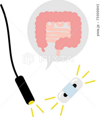 カプセル型とスコープ型　大腸カメラ　検査　 75009943