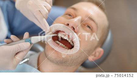 Patient with dental braces during an orthodontic treatment Patient with dental braces during an orthodontic treatment 75014152