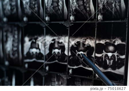 Doctor points on magnetic resonance imaging of the lumbar spine Doctor points on magnetic resonance imaging of the lumbar spine 75018627