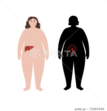 Organs in obese human body 75065990