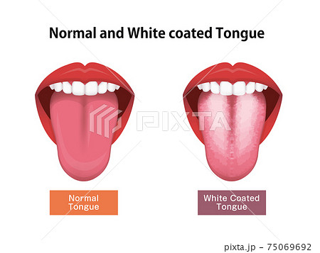 舌 白い