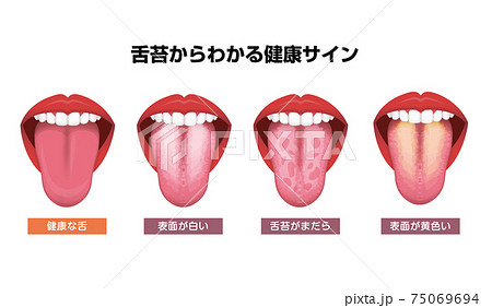舌 べろ が表す体の不調シグナル 舌苔 ベクターイラストセットのイラスト素材