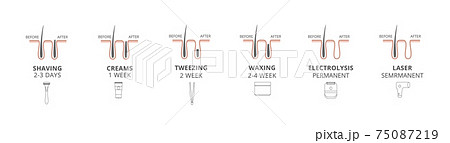 Procedure hair removal, before and after depilation a vector illustrations. 75087219
