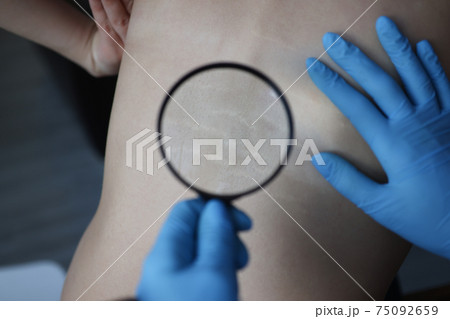 Doctor examining stretch marks on patients back using magnifying glass closeup 75092659