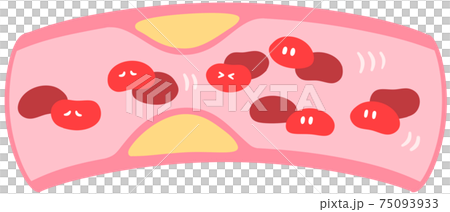 血管有斑塊 75093933