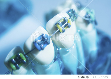 Metal teeth brackets Metal teeth brackets 75098289