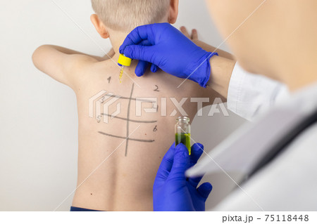An allergist in the laboratory conducts an allergy prick-test. Skin test for household, food, epidermal allergic reactions. The test is performed on the patient's back. Child at a doctor's appointment 75118448