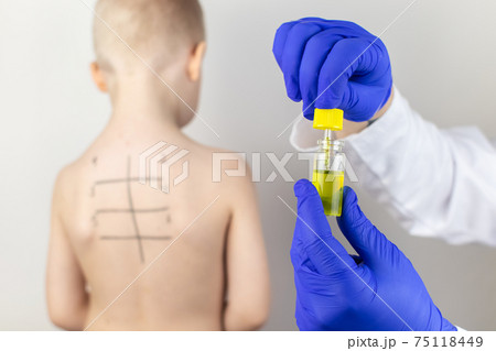 An allergist in the laboratory conducts an allergy prick-test. Skin test for household, food, epidermal allergic reactions. The test is performed on the patient's back. Child at a doctor's appointment 75118449