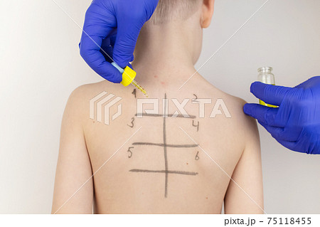 An allergist in the laboratory conducts an allergy prick-test. Skin test for household, food, epidermal allergic reactions. The test is performed on the patient's back. Child at a doctor's appointment 75118455