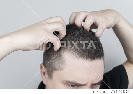 Dandruff on a man's shoulder. Side view of a man who has more dandruff flakes on his black shirt. Scalp disease treatment concept. Discomfort from a fungal infection 75170836