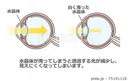 白内障の説明の図解のイラスト素材