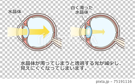 Illustrated explanation of cataract 75191116