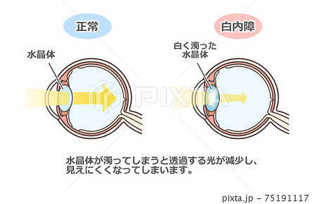 白内障の説明の図解 75191117