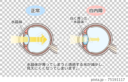 Illustrated explanation of cataract 75191117