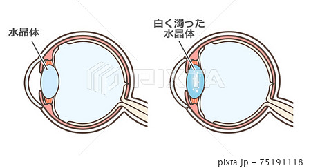 白内障の説明の図解のイラスト素材