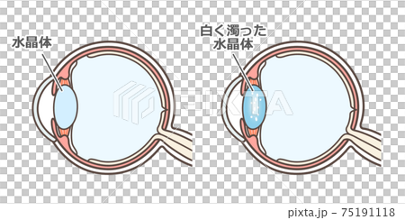 Illustrated explanation of cataract 75191118