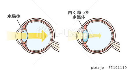 白内障の説明の図解のイラスト素材