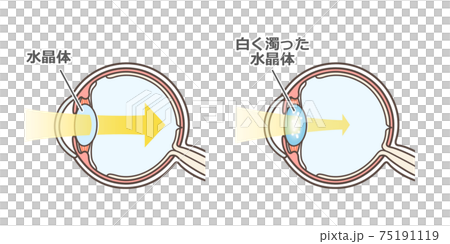 Illustrated explanation of cataract 75191119