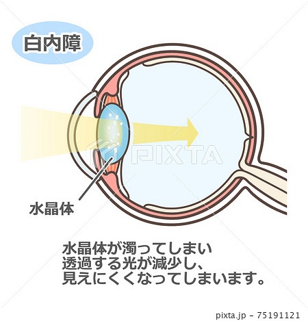 白内障の説明の図解のイラスト素材