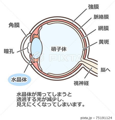 In chinese cataract Reaching Optimal