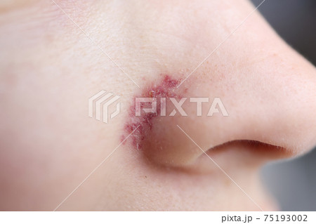 Closeup of red inflamed rash on womans nose 75193002