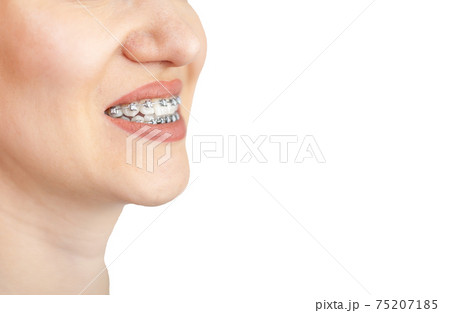 The smile of a young girl with braces on her white teeth. Teeth straightening. 75207185