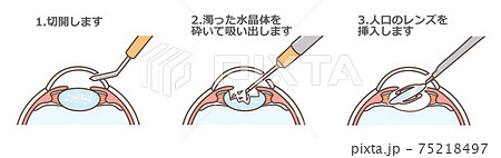 白内障 (イラスト眼科手術シリーズ 1) 徳田 芳浩; 比嘉 利沙子 白内障 (イラスト眼科手術シリーズ 1) | 徳田 芳浩, 比嘉 利沙子