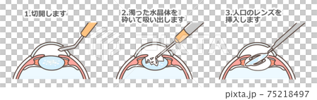 白内障手術の図解のイラスト素材