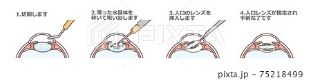 白内障手術の図解 75218499