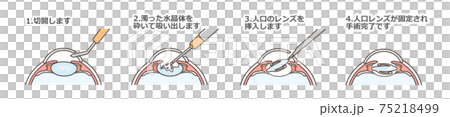 白内障手術の図解 75218499