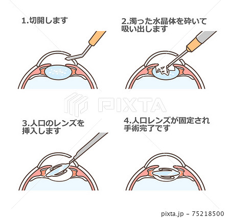 白内障手術の図解のイラスト素材