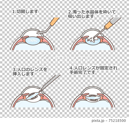 白内障手術の図解のイラスト素材