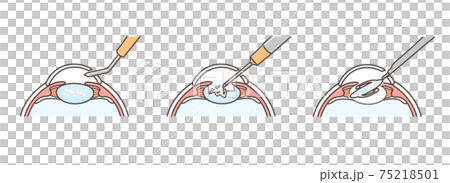 Illustration of cataract surgery 75218501